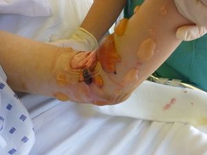 Image showing compartment syndrome in arm with blister formation