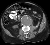 CT Scan showing rupture of an AAA