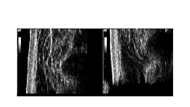 ultrasound of PAIVMs