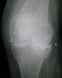 Knee osteoarthritis xray.jpg