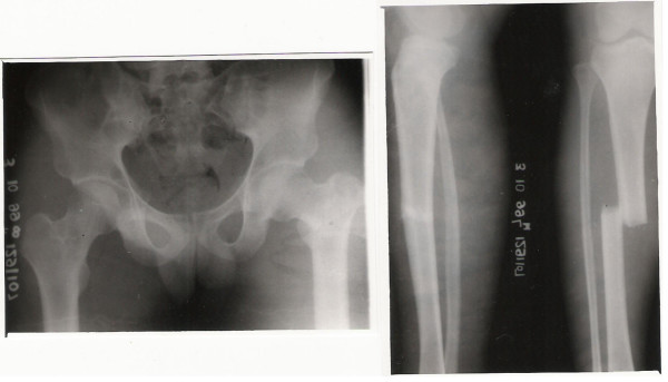 File:Floating knee fracture 3.jpg