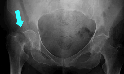Fig. 3: fractured hip