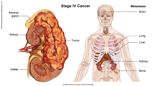File:Kidneycancerstage4b.jpg