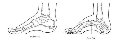 tratamentul venelor varicoase ale barocamerei varicoză pe picioarele unui unguent pentru tratament