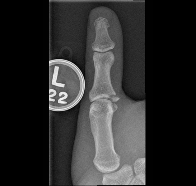 File:Skier's thumb X ray.jpeg