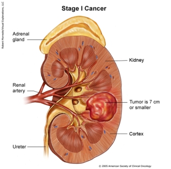 Kidneycancerstage1b.jpg