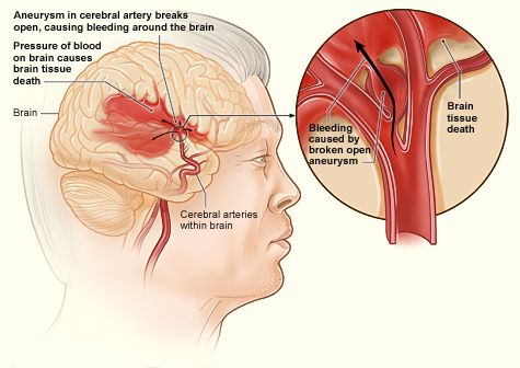 Hemorrhagic Stroke: Intracerebral Hemorrhage - Physiopedia
