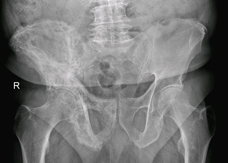 File:Paget's disease of Right Hip Bone.jpg