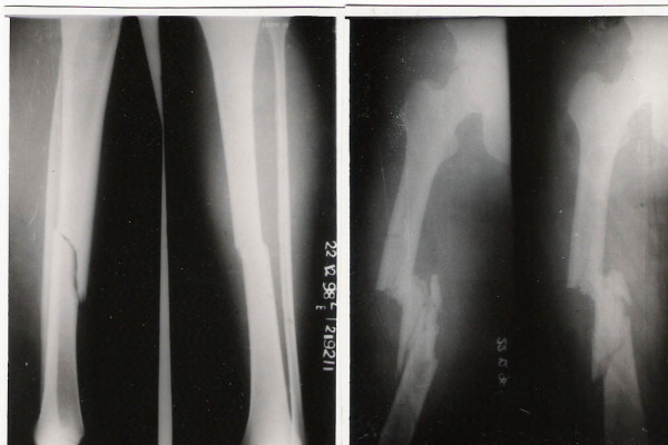 File:Floating knee fracture 1.jpg