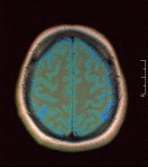 Brain normal MRI.gif