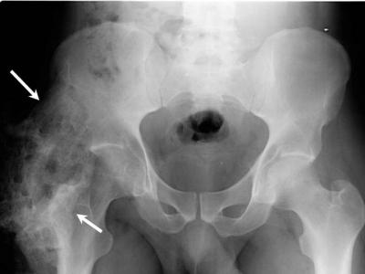Heterotopic ossification of the hip