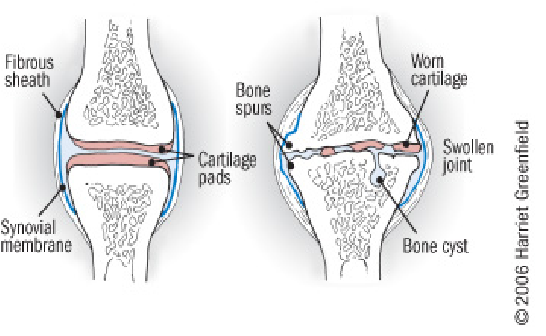 durere severă la cot medicament tratament articulația genunchiului