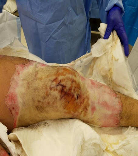 File:Subcutaneous burn leg.jpeg