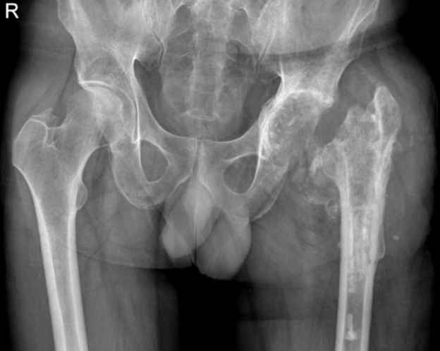 File:Girdlestone resection arthroplasty of left hip.png