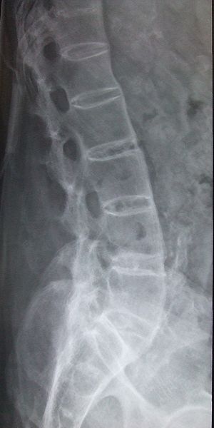 Ankylosing spondylitis lumbar spine.jpg