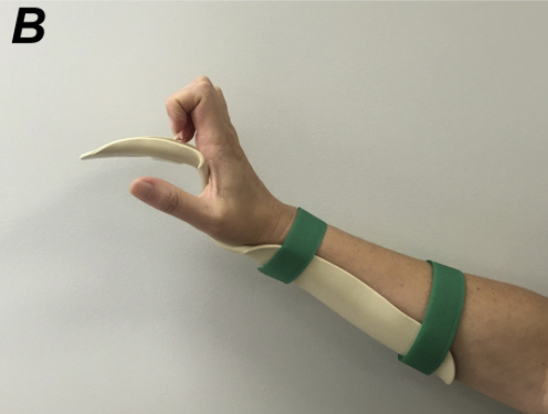File:Resting hand orthosis hook fist.png