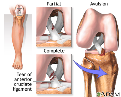 File:Anterior cruciate ligament 2.jpg