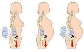 File:Low Back Pain in Pregnancy.png