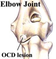 File:Elbow joint OCD lesion.jpg