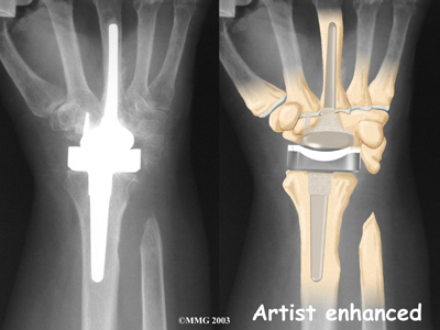 Wrist arthroplasty I.jpg