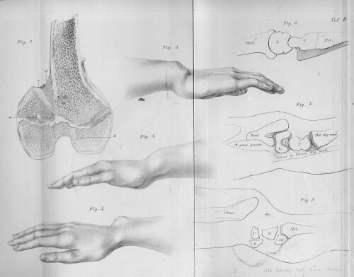Madelung S Deformity Physiopedia