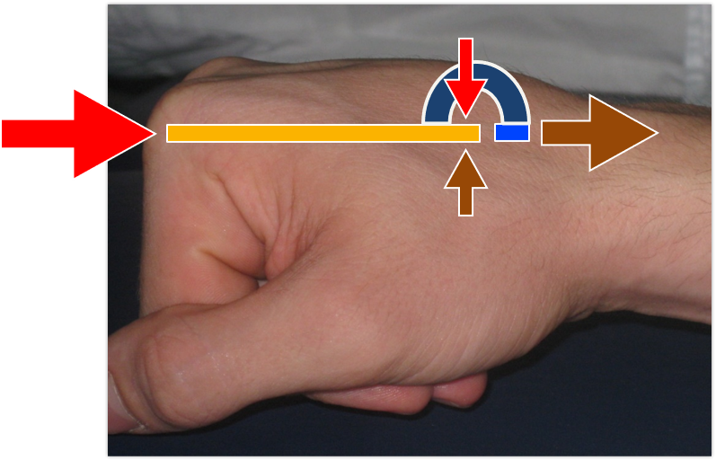 File:Injury Mechanism of the Hand.png