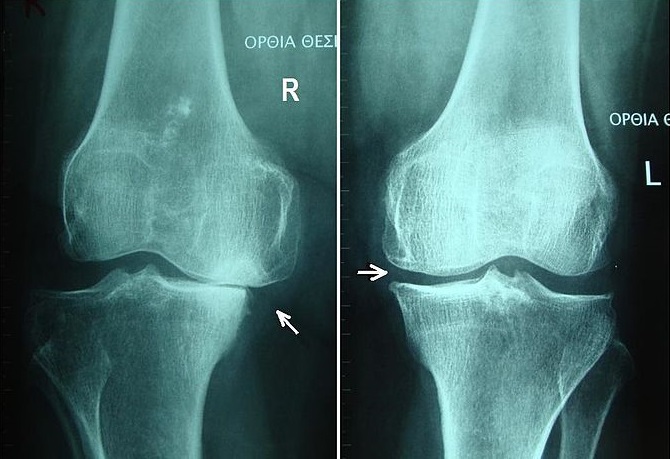 A térd deformáló artrózisának kezdeti megnyilvánulásai