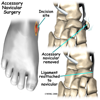 File:Accessory navicular surgery.jpg