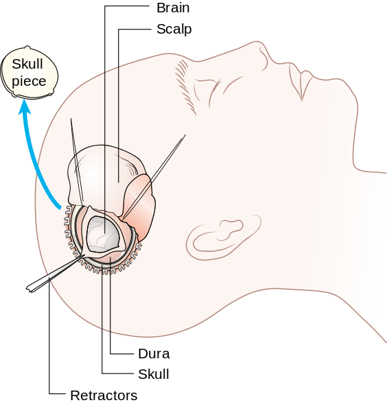 File:Diagram showing a craniotomy.png