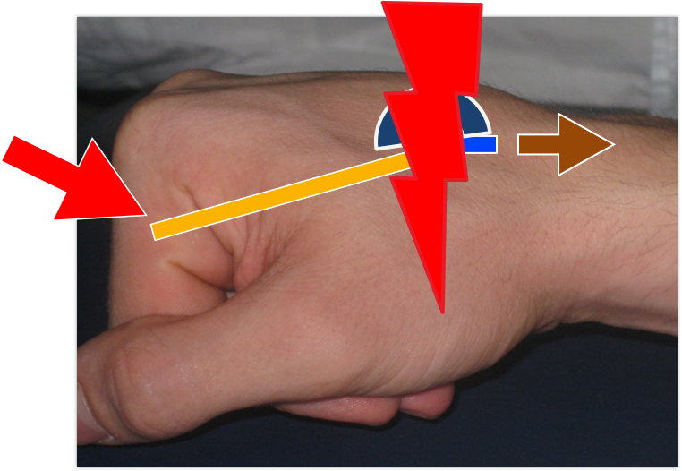 File:Injury Mechanism of the Hand 3.png