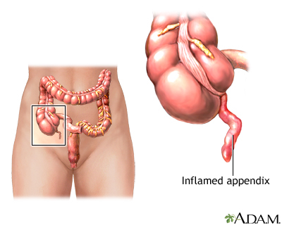 Image of Appendicitis.