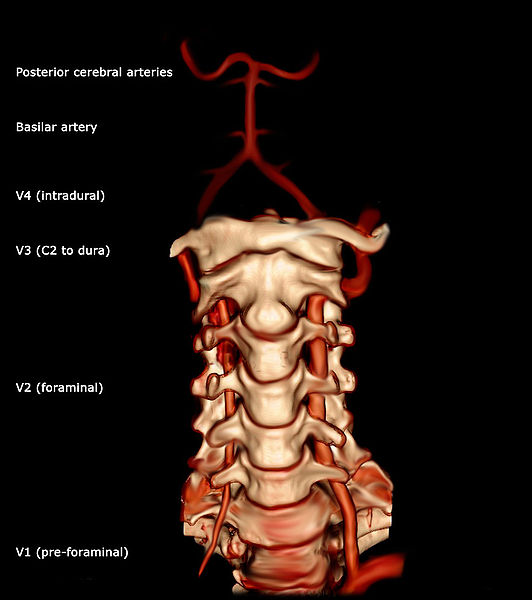 Vertebral Artery - Physiopedia