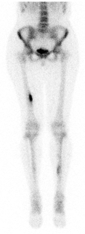 File:Right-femoral-stress-fracture.png