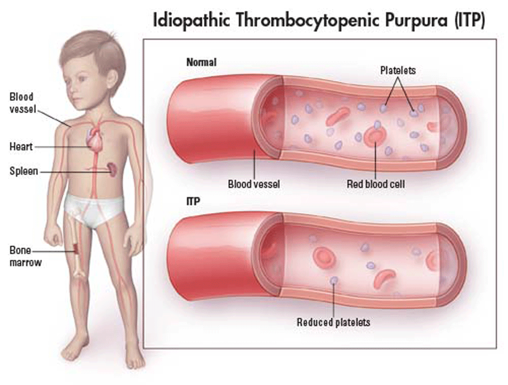 Available from: http://www.childrenshospital.org/conditions-and-treatments/conditions/immune-thrombocytopenic-purpura-itp