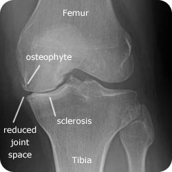 File:Radiograph for knee OA.jpg