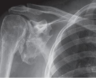 'Figure.5'"AP X-ray of Same Shoulder