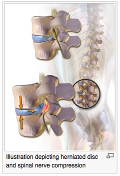 (Figure: posterior disc migration with flexion of the spine (from: http://en.wikipedia.org/wiki/Disc_herniation)