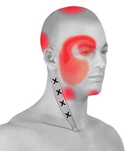 File:Areas effected by cervogenic headache.png