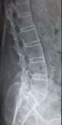 Radiograph findings of AS