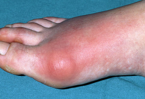Common presentation of gout at the first mtp joint.