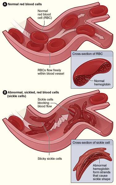 Sickle Cell Anemia - Physiopedia