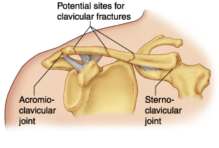 File:ClavicleFracture2.jpg
