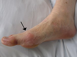 File:Gout big toe.jpeg