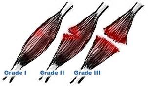 File:Muscle-strain-grades.png