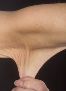 aHyper-elastic skin in a person with Ehlers-Danlos syndrome.