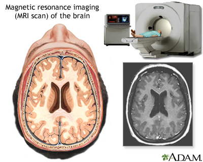 MultipleSclerosis-MRI.jpg