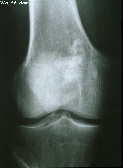 Bone Chondrosarcoma1 LowGrade(1).jpg