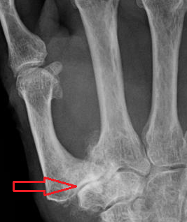 Osteoarthritis of the CMC joint(変形性関節症)。png