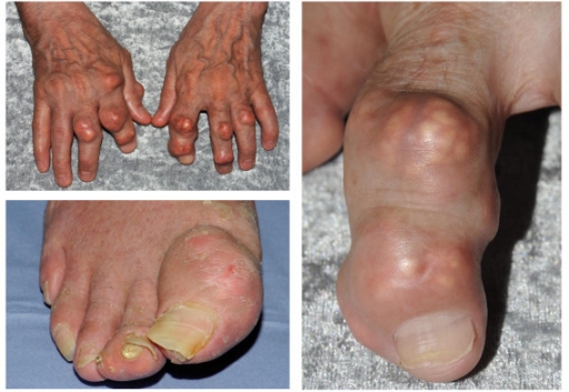File:Tophaceous gout.jpeg