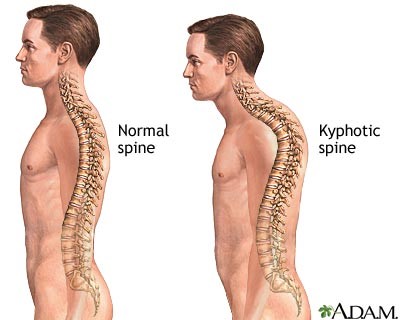 File:Kyphotic spine.jpg